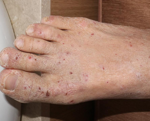 아토피성 피부염 01