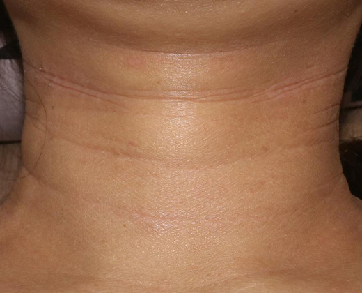 아토피성 피부염 01