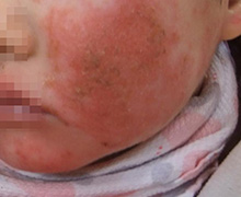 아토피성 피부염 03