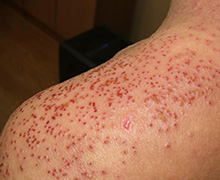 아토피성 피부염 03