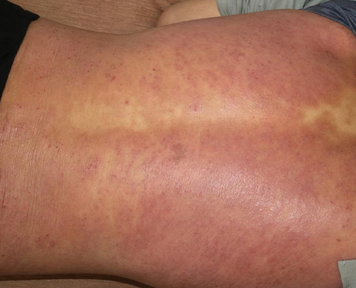 아토피성 피부염 키비주얼