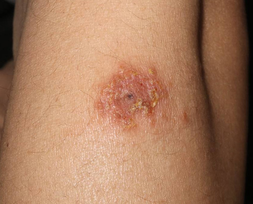 화폐상 습진 키비주얼