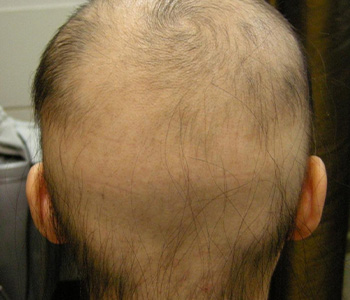 원형탈모 01