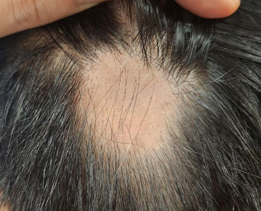 원형탈모 키비주얼