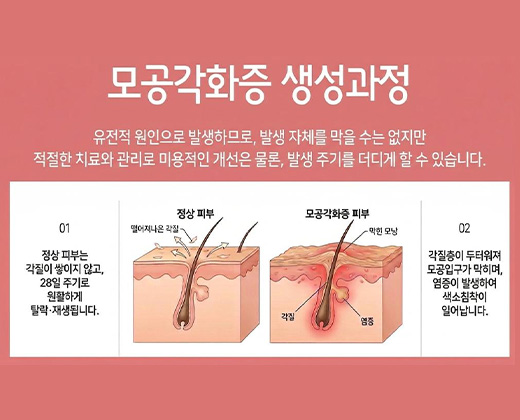 모공각화증 키비주얼