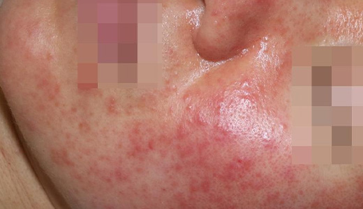 지루성 피부염 01